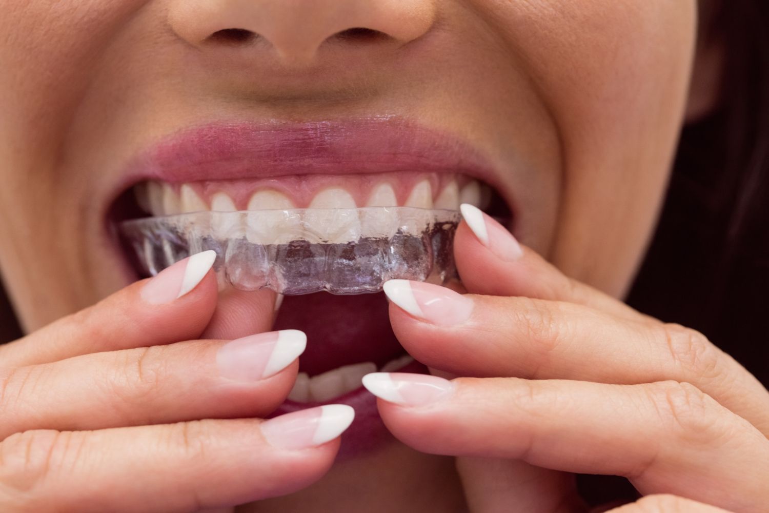 eating with invisalign