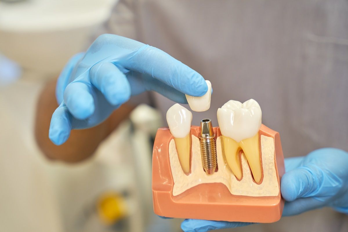 dental implants in swartz creek
