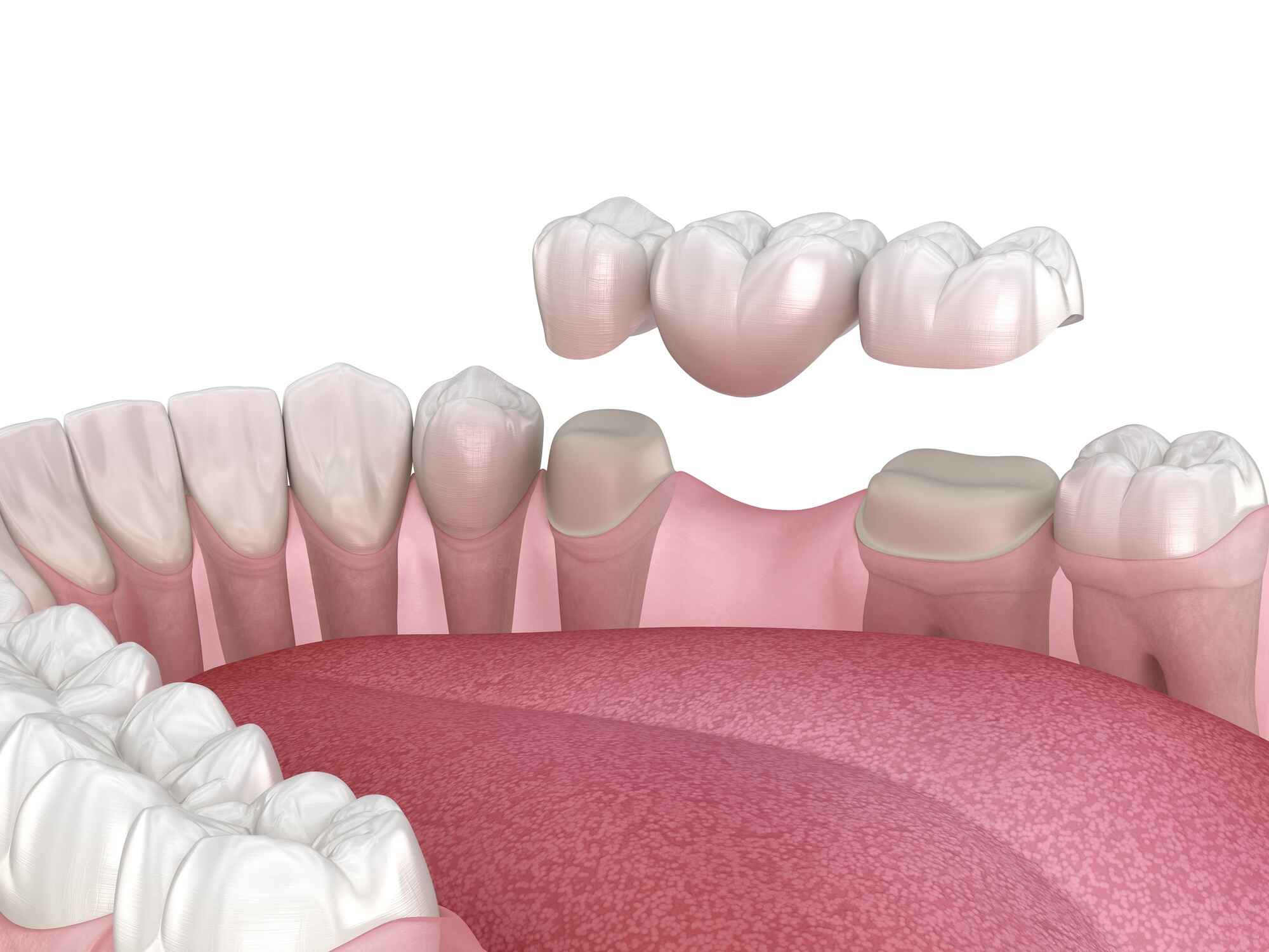 dental crowns in swartz creek